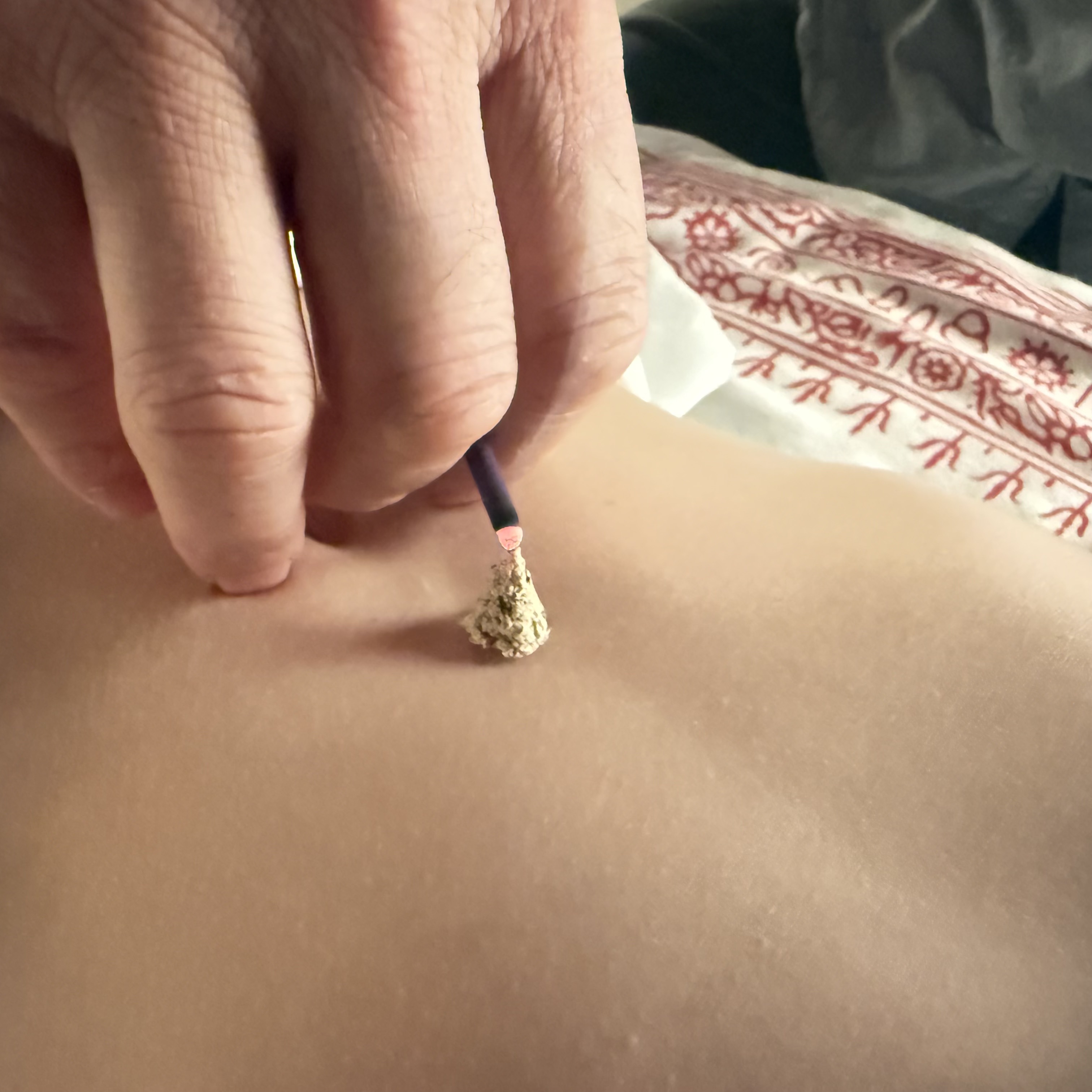 Moxibustion photo